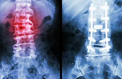 Is This the Tipping Point in Spinal Surgery? 