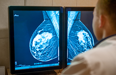 5 Mammogram Start-ups that are Revolutionising Breast Cancer Detection.